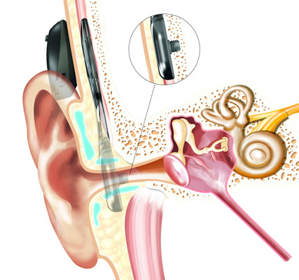 diagram of how a Bone Anchored Hearing Device is implanted